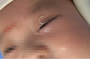 Mẹ c:;ắt móng tay văng vào mắt, cháu bé 2 tháng tuổi l:âm ng:uy Mẹ c:;ắt móng tay văng vào mắt, cháu bé 2 tháng tuổi l:âm ng:uy