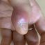 Cậu bé suýt bị cắt cụt chi chỉ vì cắn móng tay thường xuyên