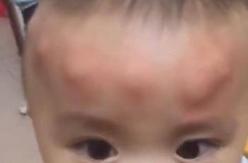 Con trai 2 tuổi ngủ dậy trên đầu liền xuất hiện nhiều khối u bất thường, người mẹ tá hoả khi biết nguyên nhân Con trai 2 tuổi ngủ dậy trên đầu liền xuất hiện nhiều khối u bất thường, người mẹ tá hoả khi biết nguyên nhân