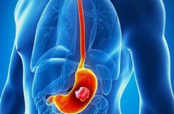 9 triệu chứng UT dạ dày giai đoạn đầu giúp phát hiện sớm bệnh