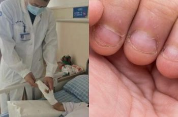 Thường xuyên cắn móng tay, bé 9 tuổi nhập viện phẫu thuật ba lần mới qua khỏi, mẹ ray rứt vì ngỡ bình thường
