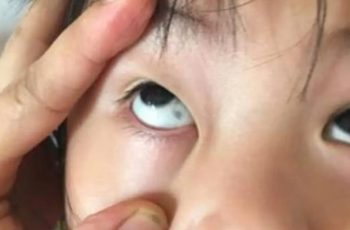 Phát hiện đốm đen trong tròng mắt con, gia đình hoang mang nhanh chóng cho bé nhập viện và cái kết không ngờ Phát hiện đốm đen trong tròng mắt con, gia đình hoang mang nhanh chóng cho bé nhập viện và cái kết không ngờ