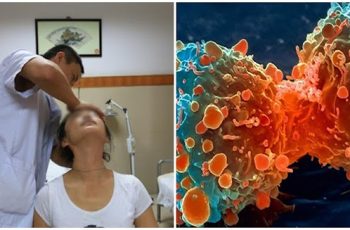 Nếu có polyp trong ru:ột, khi đi vệ sinh sẽ có 4 dấu hiệu này, đi khám ngay kẻo muộn