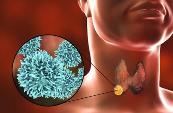Cảnh báo: U tuyến giáp lành tính mà gặp dấu hiệu này là phải đi khám gấp Cảnh báo: U tuyến giáp lành tính mà gặp dấu hiệu này là phải đi khám gấp