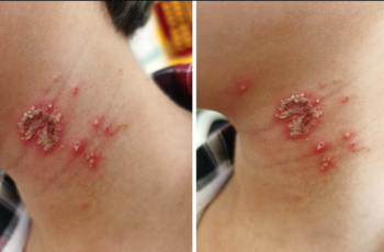 Bé trai 10 tuổi bỗng xuất hiện những nốt mẩn lạ trên da nhưng vẫn chưa tìm ra được nguyên nhân Bé trai 10 tuổi bỗng xuất hiện những nốt mẩn lạ trên da nhưng vẫn chưa tìm ra được nguyên nhân
