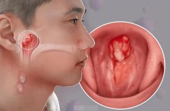7 dấu hiệu K vòm họng: Số 1 không biết sớm khó mà chữa 7 dấu hiệu K vòm họng: Số 1 không biết sớm khó mà chữa