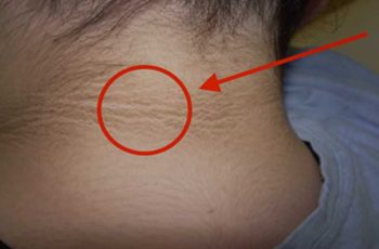 Dấu hiệu “lạ” trên cổ cảnh báo căn bệnh đáng sợ cha mẹ nên để ý ở con Dấu hiệu “lạ” trên cổ cảnh báo căn bệnh đáng sợ cha mẹ nên để ý ở con