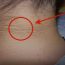 Dấu hiệu “lạ” trên cổ cảnh báo căn bệnh đáng sợ cha mẹ nên để ý ở con