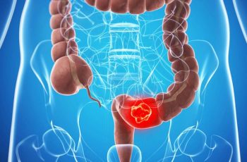 Triệu chứng UT đại tràng giai đoạn đầu, không nên bỏ qua Triệu chứng UT đại tràng giai đoạn đầu, không nên bỏ qua